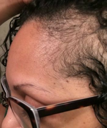 How to Use a Dermaroller on Your Edges + 6 More Tips to Help Grow Your Edges Back
