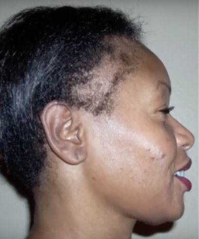 7 Ways to Grow Your Edges Back and Treat a Thinning Hairline
