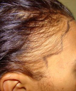 New Research Confirms Why Black Women Are At Greater Risk For Pattern Baldness
