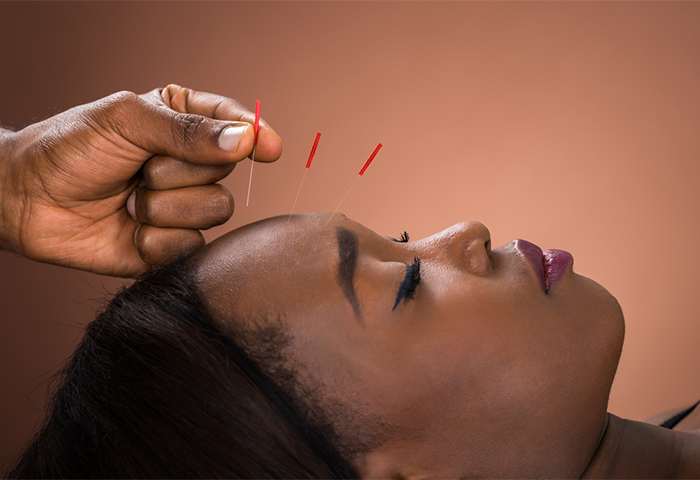 Can Acupuncture Affect Hair Growth