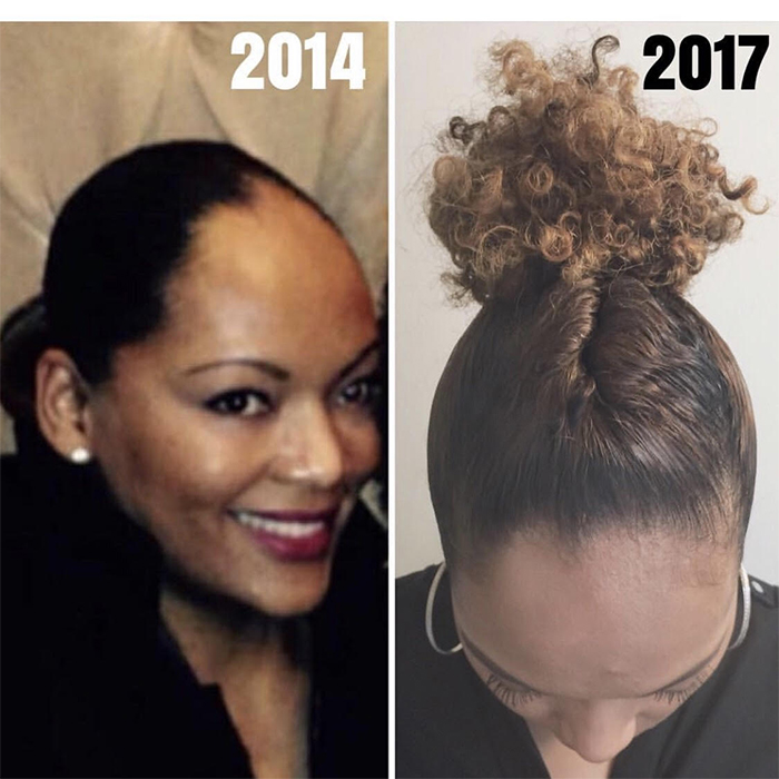 5 Jaw Dropping Hair Growth Transformations You Must See