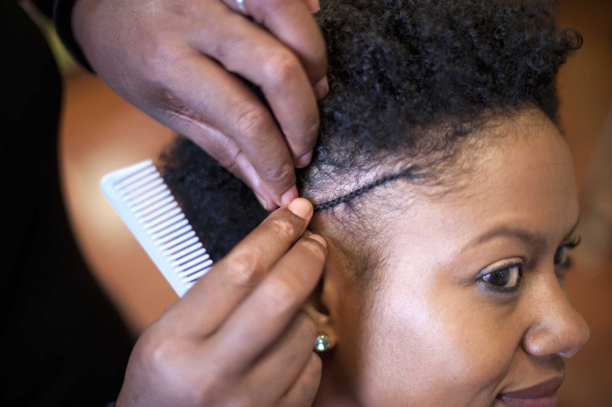 What You Need to Know About Traction Alopecia